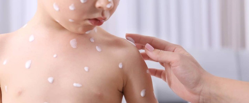 Zdjęcie przedstawia leczenie ospy wietrznej u dziecka