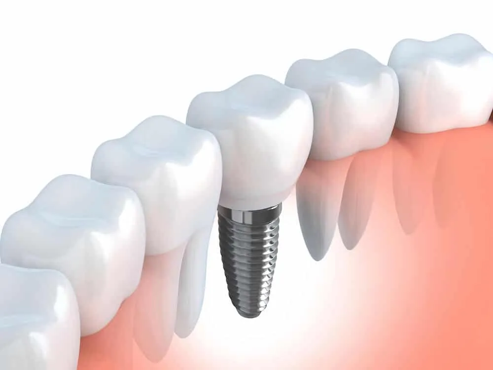 Zdjęcie przedstawia implant zębowy.