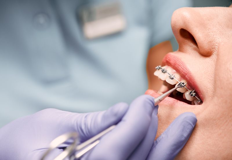 Zakładanie aparatu ortodontycznego