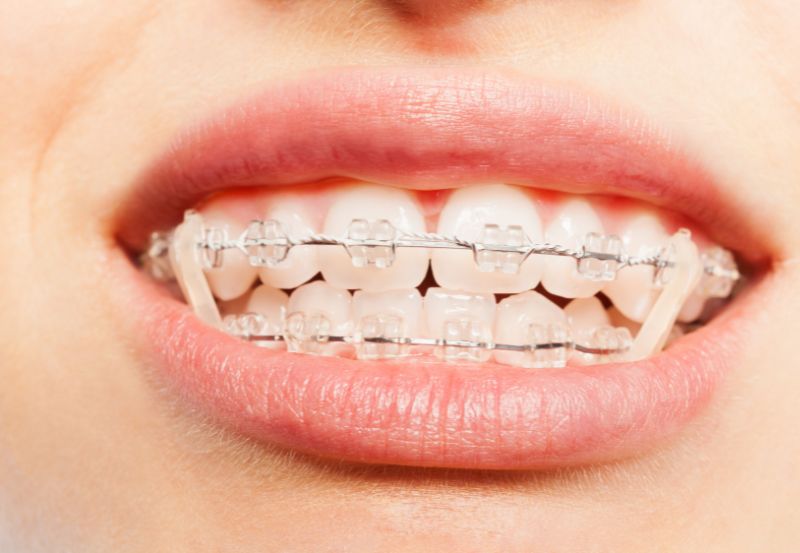 gumki separacyjne przy aparacie ortodontycznym