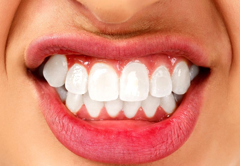 objawy bruksizmu - zaciskanie zębów