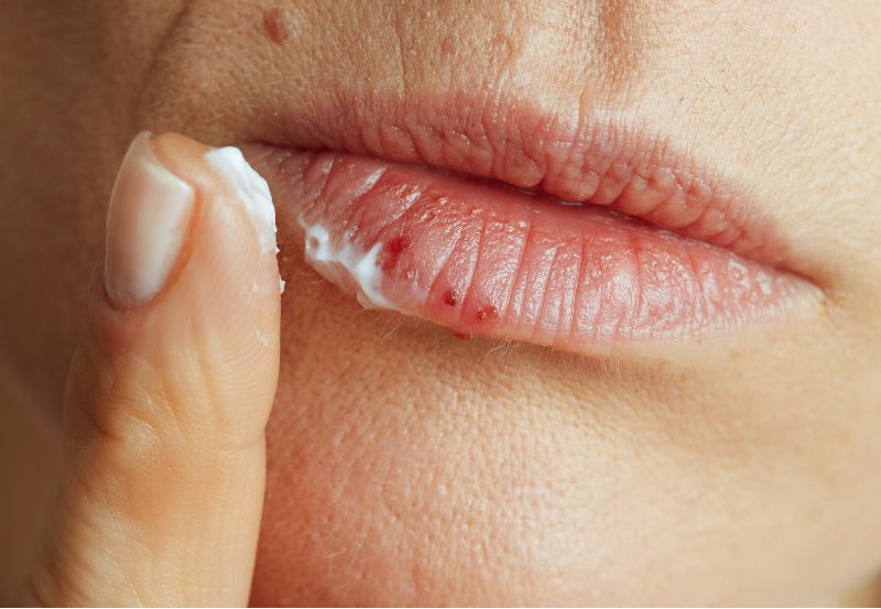 Czy opryszczka wargowa jest zaraźliwa