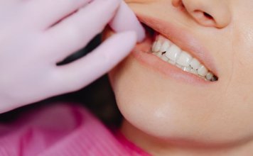 Lakowanie zdrowych zębów mlecznych – klucz do profilaktyki próchnicy u dzieci Lakowanie zdrowych zębów mlecznych - klucz do profilaktyki próchnicy u dzieci