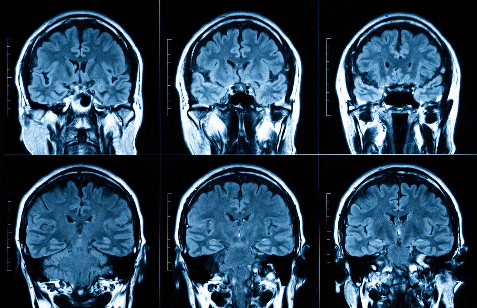 Zwykłe zapominanie a łagodne zaburzenia poznawcze – objawy i diagnostyka