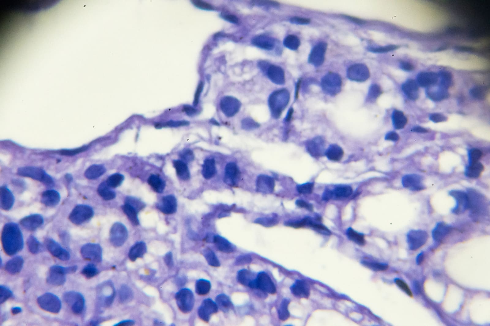 Guzki tarczycy – kiedy wymagają biopsji i jak wygląda diagnostyka?