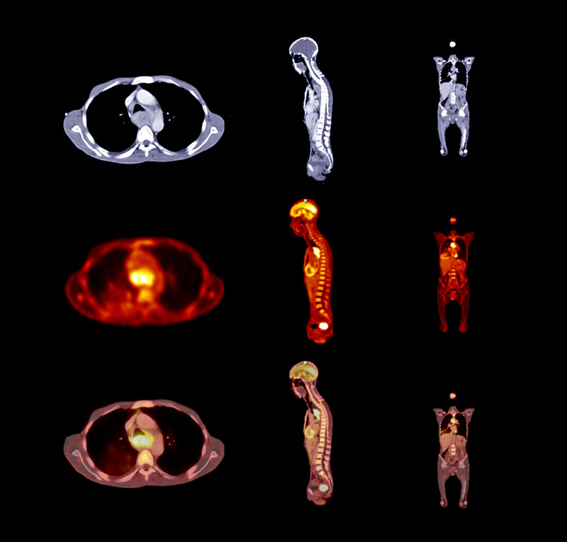Badanie PET-CT – zastosowanie, przygotowanie i interpretacja wyniku