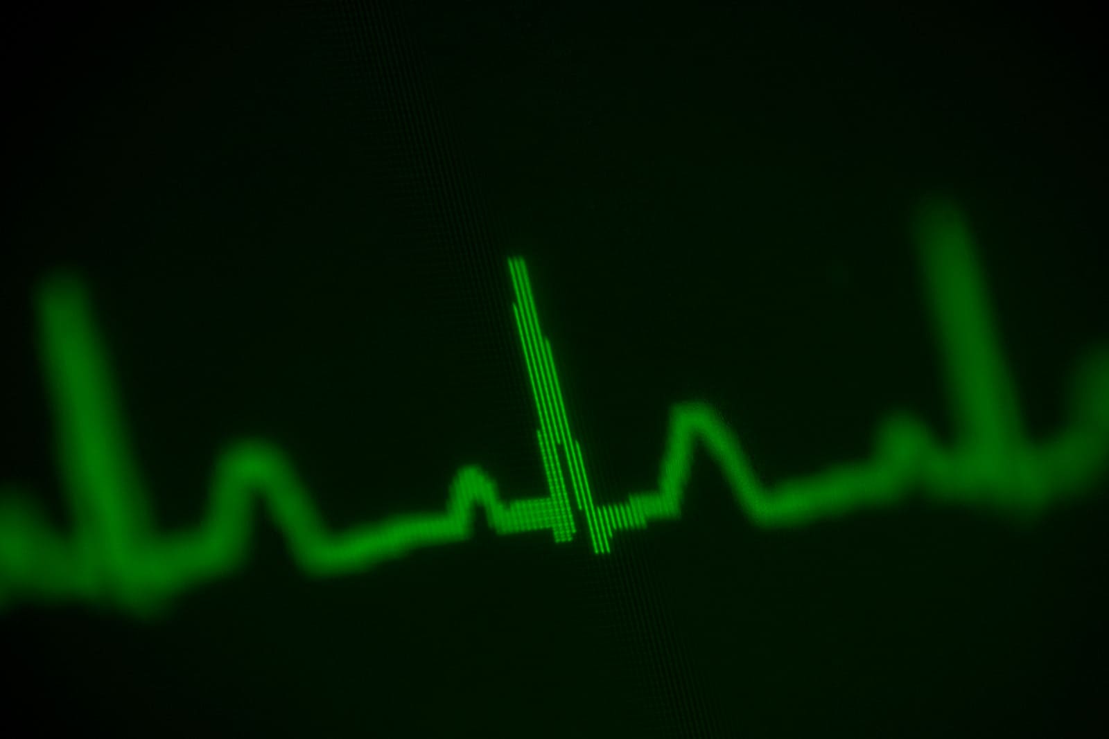 Rytm zatokowy w zapisie EKG
