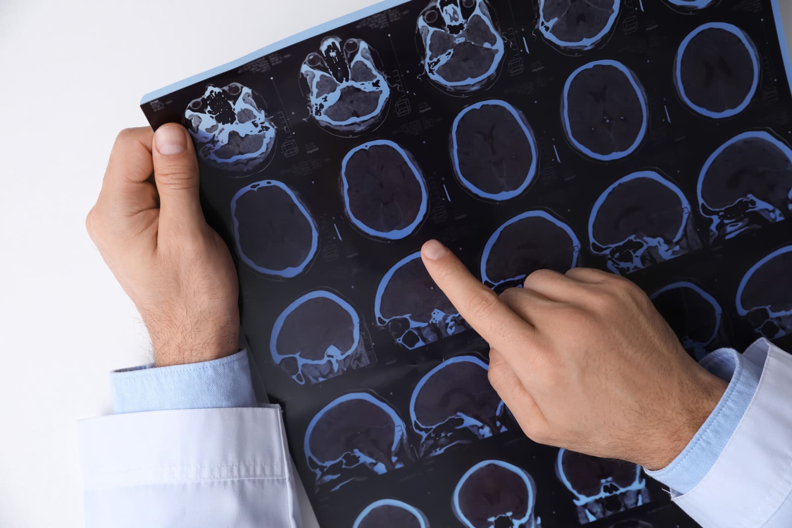 Stwardnienie rozsiane – pierwsze niespecyficzne objawy, diagnostyka i leczenie